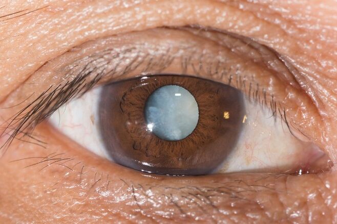For cataracts, exercises to improve vision are indicated.