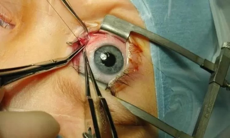 Performing eye surgery using an eyelid speculum