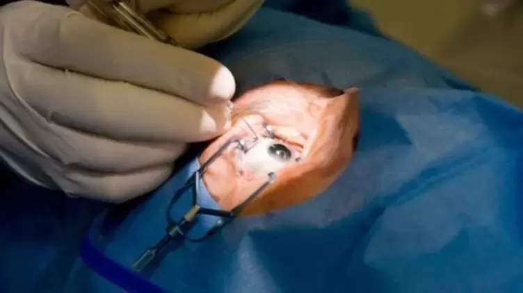 Vitrectomy – removal of the vitreous body of the eye